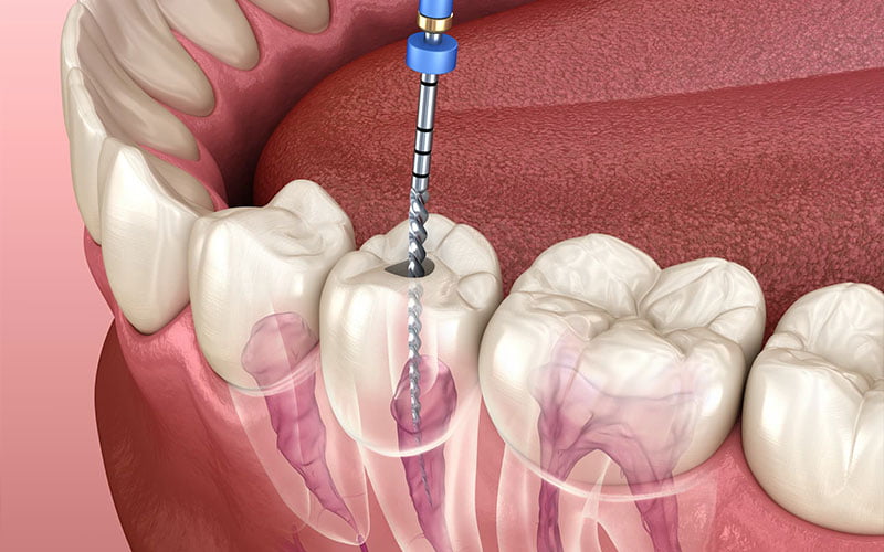 Root Canal Treatment