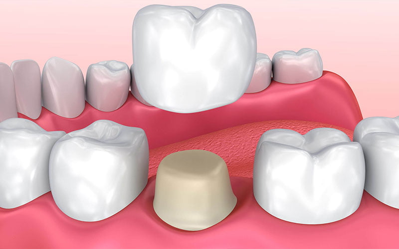 Zirconium Crown