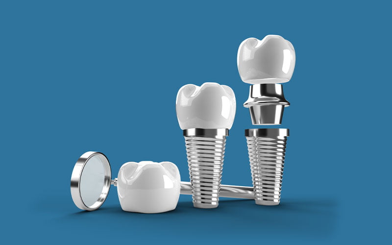 Dental Implants